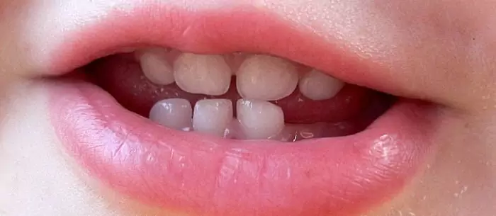 baby teeth