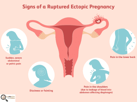 Ectopic pregnancy and its treatment