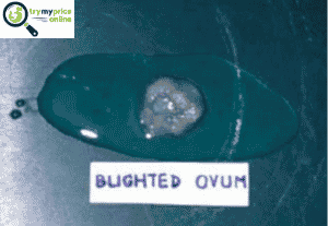 Blighted ovum symptoms
