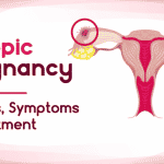 Ectopic pregnancy treatment options