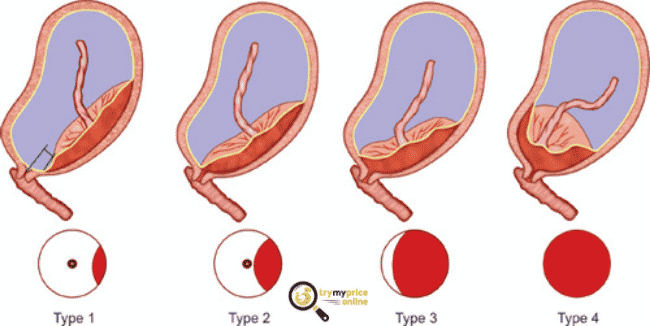 Anterior placenta what is it