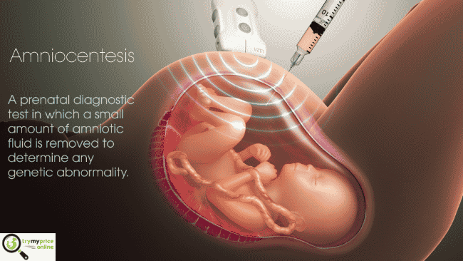 Amniocentesis what causes it?