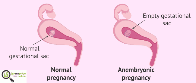 Blighted ovum causes and symptoms